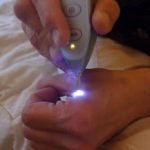 דיקור בלייזר