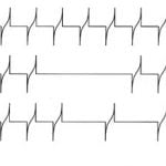 טיפול באלקטרו אקופונטורה ב- Superspinatus
