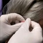 טכניקות הקזה בדיקור סיני