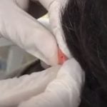 הקזה של Ear Apex