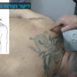 הדגמה של דיקור נקודות טריגר טרפזיוס קורס מתקדם בדיקור