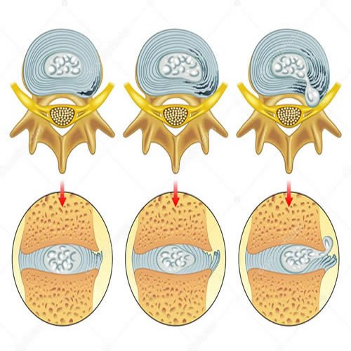 טיפול בפריצת דיסק עם דיקור סיני
