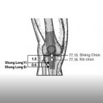 טיפול באדנומה בפטמה עם דיקור סיני, בעזרת האקופונקטורה של מאסטר דונג עם תוצאות מפתיעות.